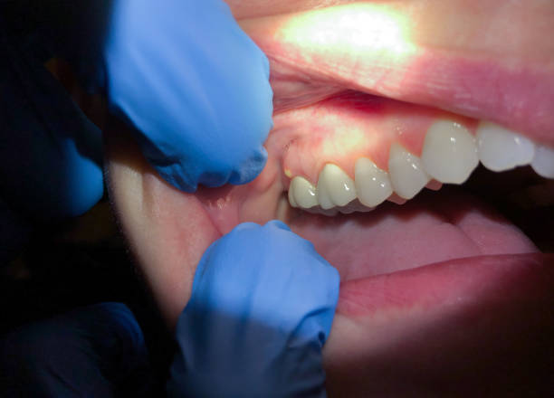 Best Dental Abscess Treatment in Meadville, PA